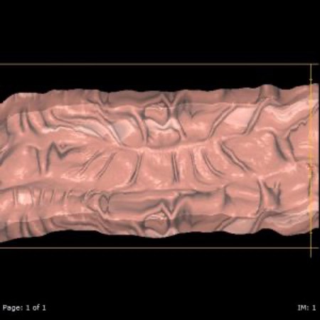 Lumen of the Colon | CT Colonography | FMIG