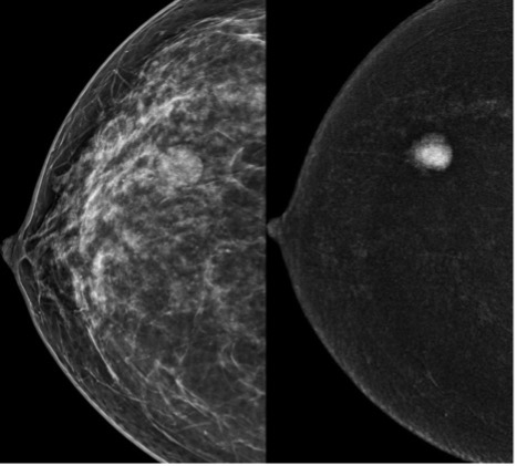 Mammogram Result | Contrast Enhanced Mammography | FMIG