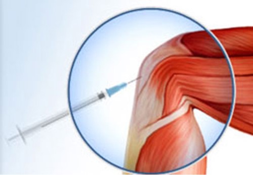PRP Injection for Knee | Platelet Rich Plasma | FMIG